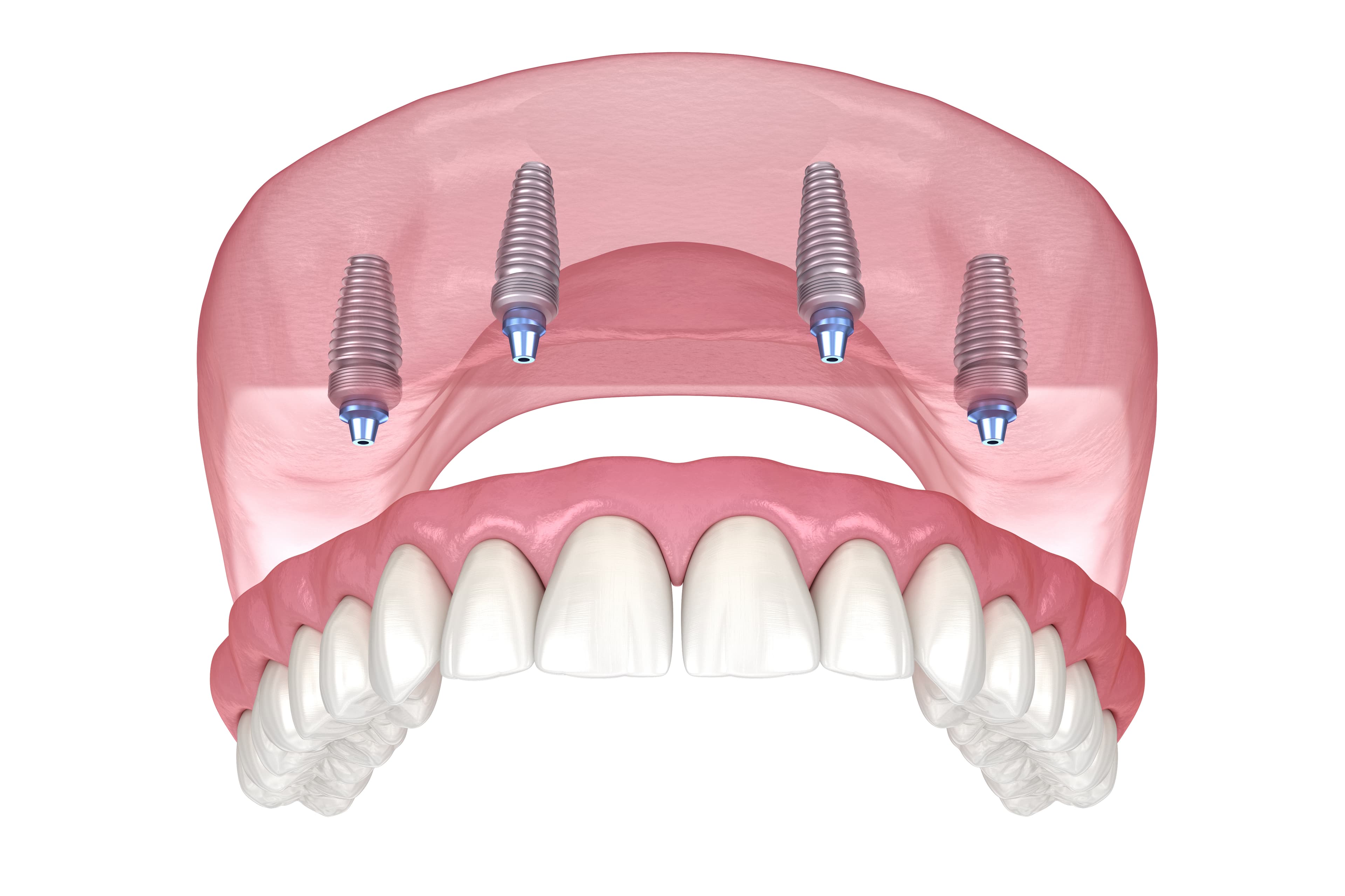Implant Denture - Spreckels Park Dental