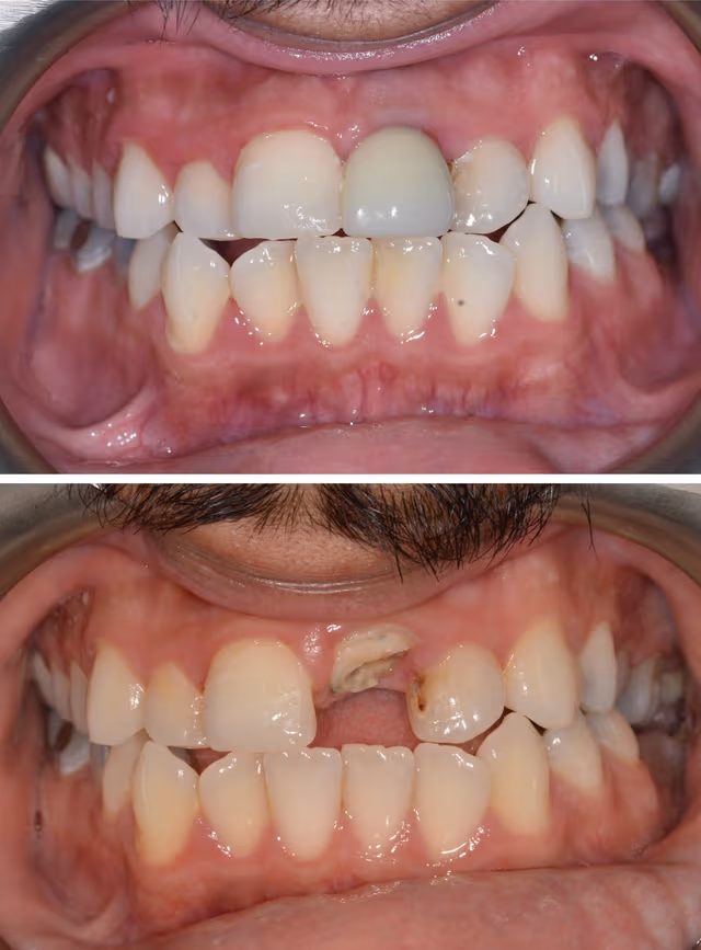 Smile Gallery - Complete Smile Restoration