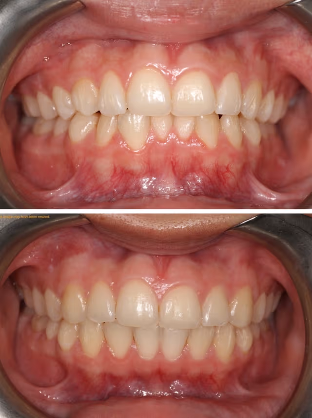 Smile Gallery - Beautiful Smile Makeover