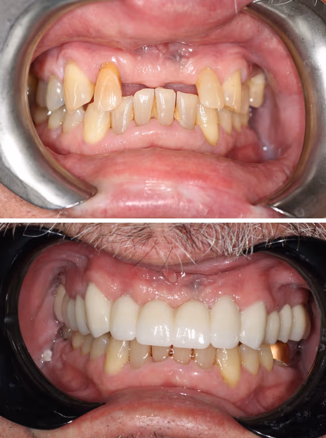 Smile Gallery - Pristine Smile Transformation