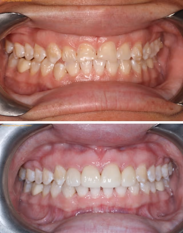 Cosmetic Dentistry Before & After