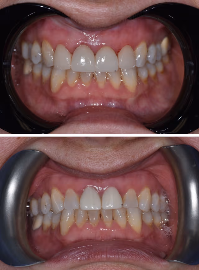 Cosmetic Dentistry Before & After