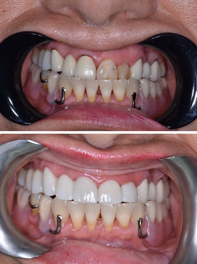 Dental Implants Before & After